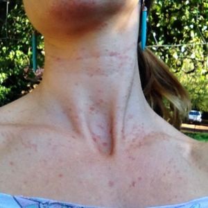 Syringoma on the neck